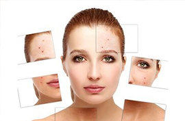 Acne Vulgaris