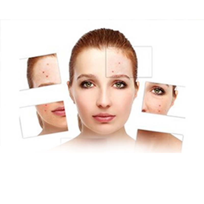 Acne Vulgaris