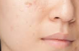 Hyperpigmentation