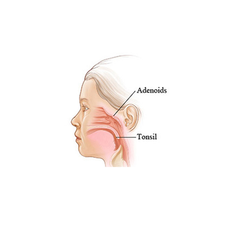 Adenoids